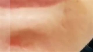 تزریق ژل لب بدون درد