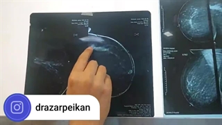ترتیب صحیح درمان سرطان پستان