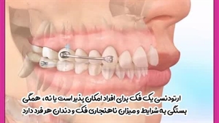 ارتودنسی رفع غبغب