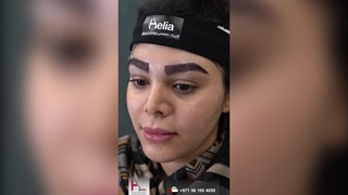 زراعة الحواجب؛ طریقة لاستعادة الحواجب المفقودة أو المنخفضة