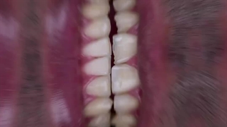 معجزه لمینت برای آقایان