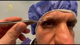 عمل زیبایی افتادگی پلک | جراحی بلفاروپلاستی