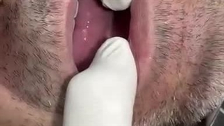 دست دندان مصنوعی با ریتنشن کلینیک مستر دندان