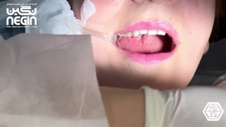 قالب گیری پست دندان | کلینیک دندانپزشکی نگین