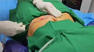 کشیدن و تزریق چربی با دستگاه پزشکی Lipo Modeling