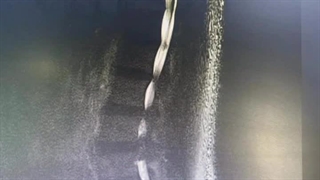 درمان تنگی شدید کانال نخاعی