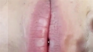 متخصص تزریق ژل لب در کرج