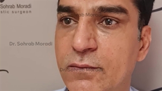 لیفت اندوسکوپی ابرو