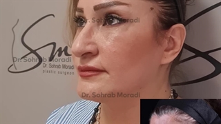 لیفت کامل صورت