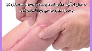 درمان اسکار برجسته کاشت مو