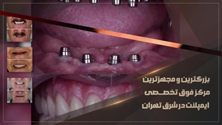 مرکز تخصصی ایمپلنت دندان در تهران