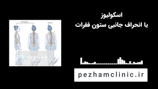 اسکولیوز یا انحراف جانبی ستون فقرات چیست؟ | کلینیک پژم
