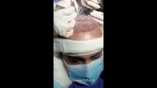 کاشت مو به روش MICRO FIT جرمگیری