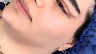 رفع افتادگی پلک در یک جلسه بدون رد بخیه در مجهزترین کلینیک