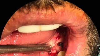 ایمپلنت دندان آقای ملگ زاده توسط دکتر حمید پورصادقی در تهران