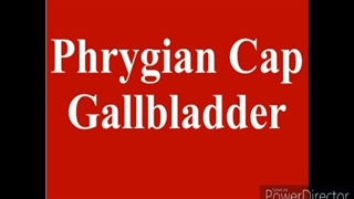 کیسه صفرا بشکل کلاه فینیقی