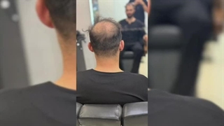 پروتز مو کرج | ورناپ